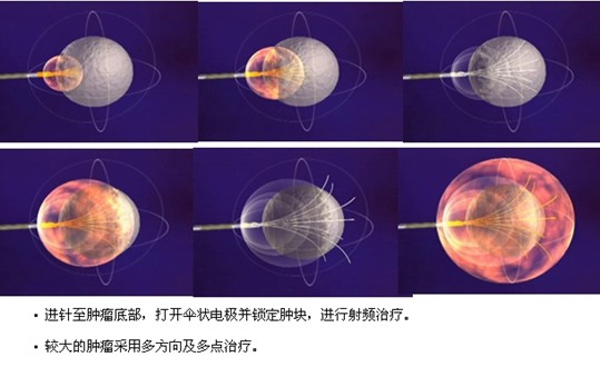 图为美国RITA公司射频电极针治疗原理