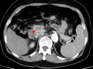 箭头示为患者三的胰头部恶性肿瘤