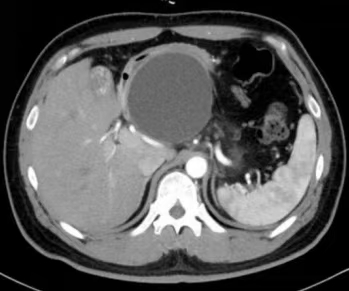 术前CT 显示胰头假性囊肿