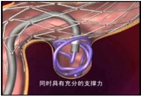 支架辅助弹簧圈填塞