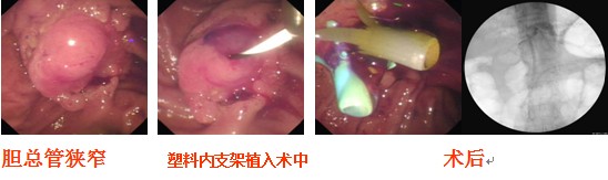 胆管支架手术过程图片