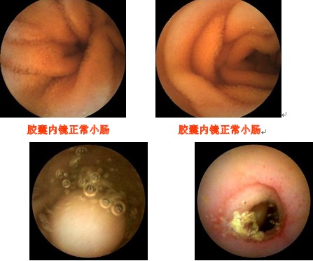 双气囊电子小肠镜图片