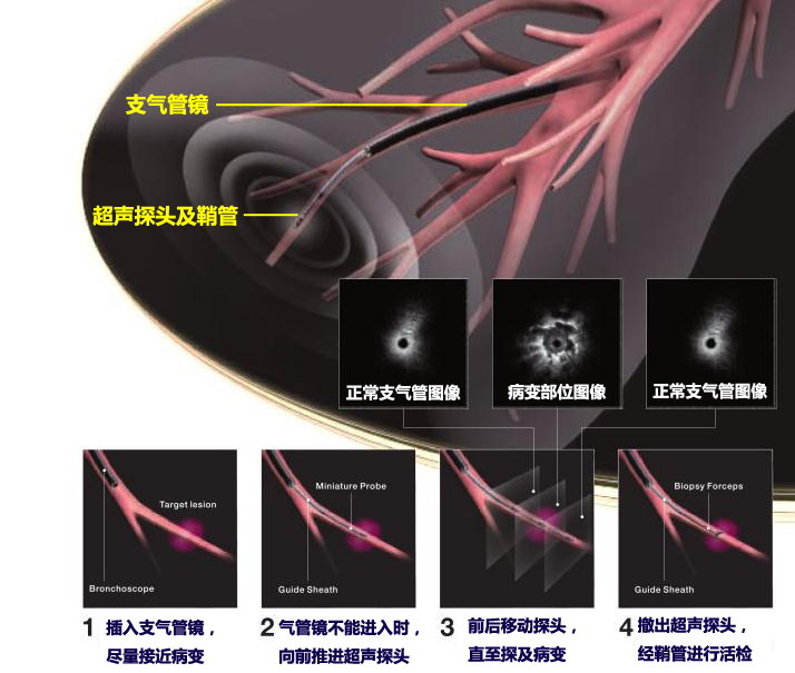 EBUS-GS工作原理