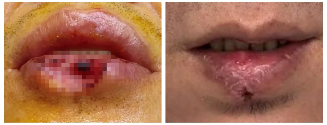 左图为手术前，右图为术后复查