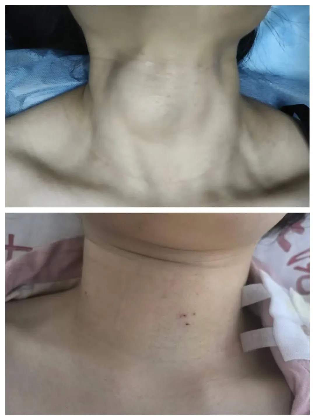 消融前后对比图