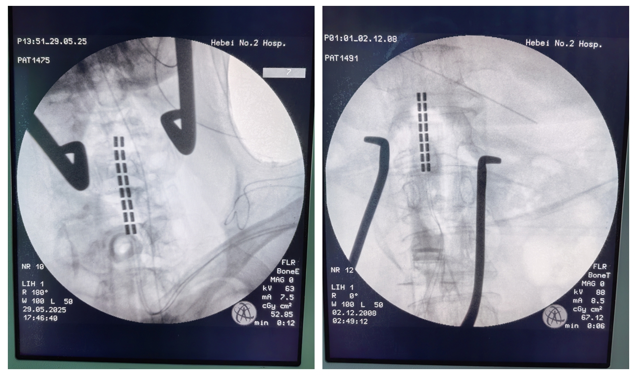 （颈椎电极；腰椎电极）